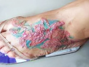 Information about allergic reactions caused by tattoo ink 2 image 4510