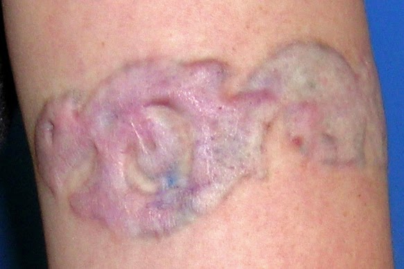 Are there any risks of scaring? 8 53235